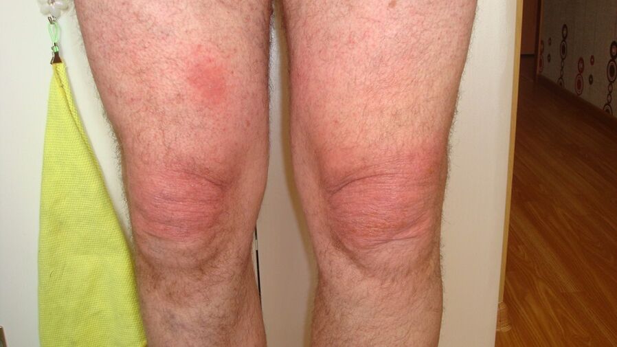 artróza kolenných kĺbov